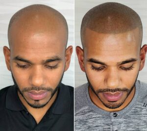 scalp micropigmentation