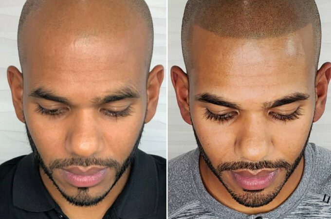 What To Expect From Scalp Micropigmentation